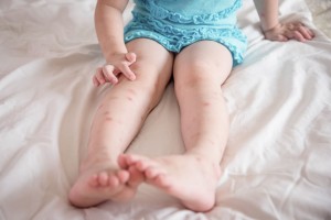 Alergia u dzieci - rodzaje, objawy, sposoby leczenia