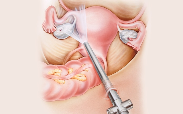 Laparoskopia w endometriozie