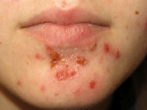 Liszajec  zakaźny (Impetigo contagiosa)