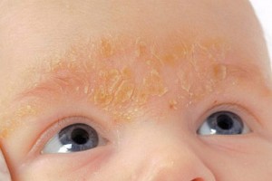 Łojotokowe zapalenie skóry u niemowląt