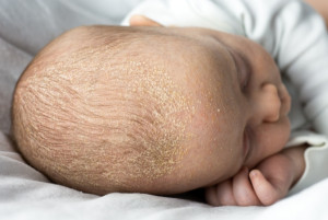 Łuszczące się brwi u niemowlaka - co oznaczają