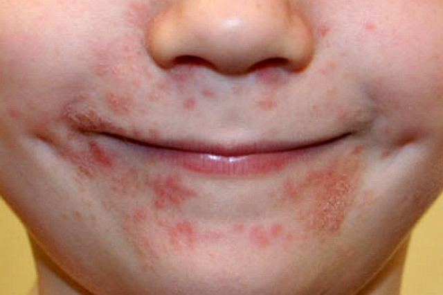 Zapalenie skóry u dzieci koło ust