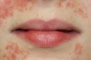 Zapalenie skóry okolicy ust