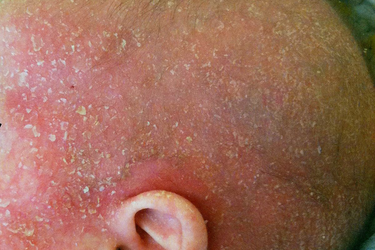 Atopowe zapalenie skóry u dzieci (AZS)