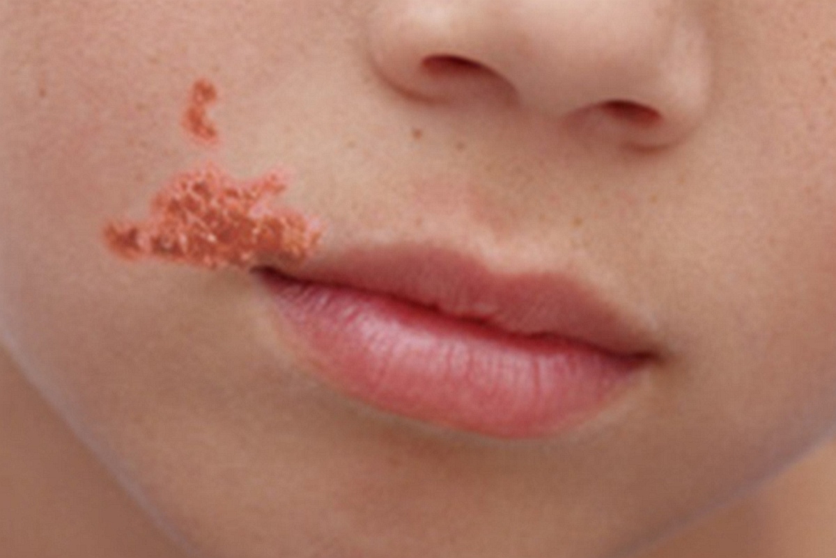 Liszajec  zakaźny (Impetigo contagiosa)