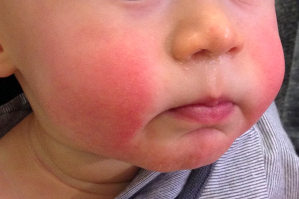 Rumień zakaźny u dzieci